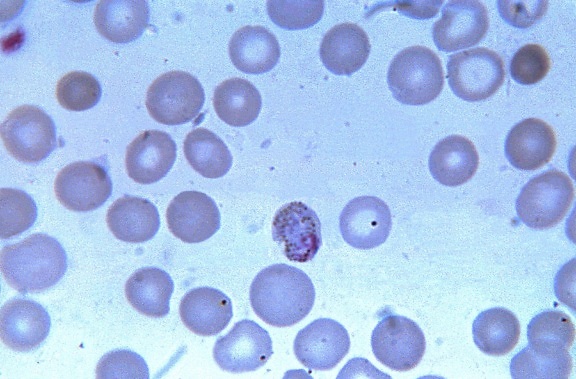 μικρογραφία δείχνει, Ώριμο, χρωματισμένο, malariae, trophozoite, τεντωμένο, χρωματίνη, ακανόνιστο, κυτταρόπλασμα