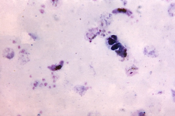 Note que dois, alongada, plasmodium falciparum, gametócitos, três, quatro, crescendo, vivax do plasmodium, trofozoítos