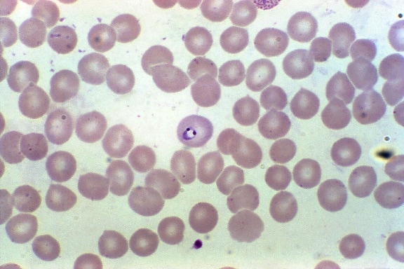 microphotographie, frottis de sang, révélant, érythrocytes, plasmodium vivax, parasite, grossie, 1000x