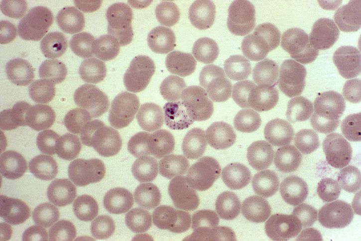 microfotografía, muestra de sangre, eritrocitos, desarrollo, vivax, parásitos, magnificados, 1000x