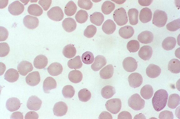 Fotomicrografia de esfregaço de sangue, plasmodium malariae, parasitas, infectando, hemácias, anel, estágio