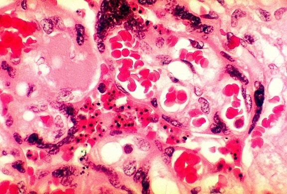 photomicrograph, placenta, vävnad, avslöjande, närvaro, malaria, parasit Plasmodiumfalciparum