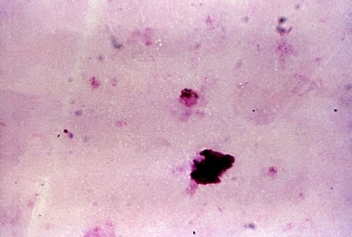 Plasmodium falciparum, gametocyte, zložené, prevažne, pigmentované, Chromatinu