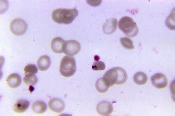 Plasmodium falciparum malaria parasiet, bloed, monster, patiënt