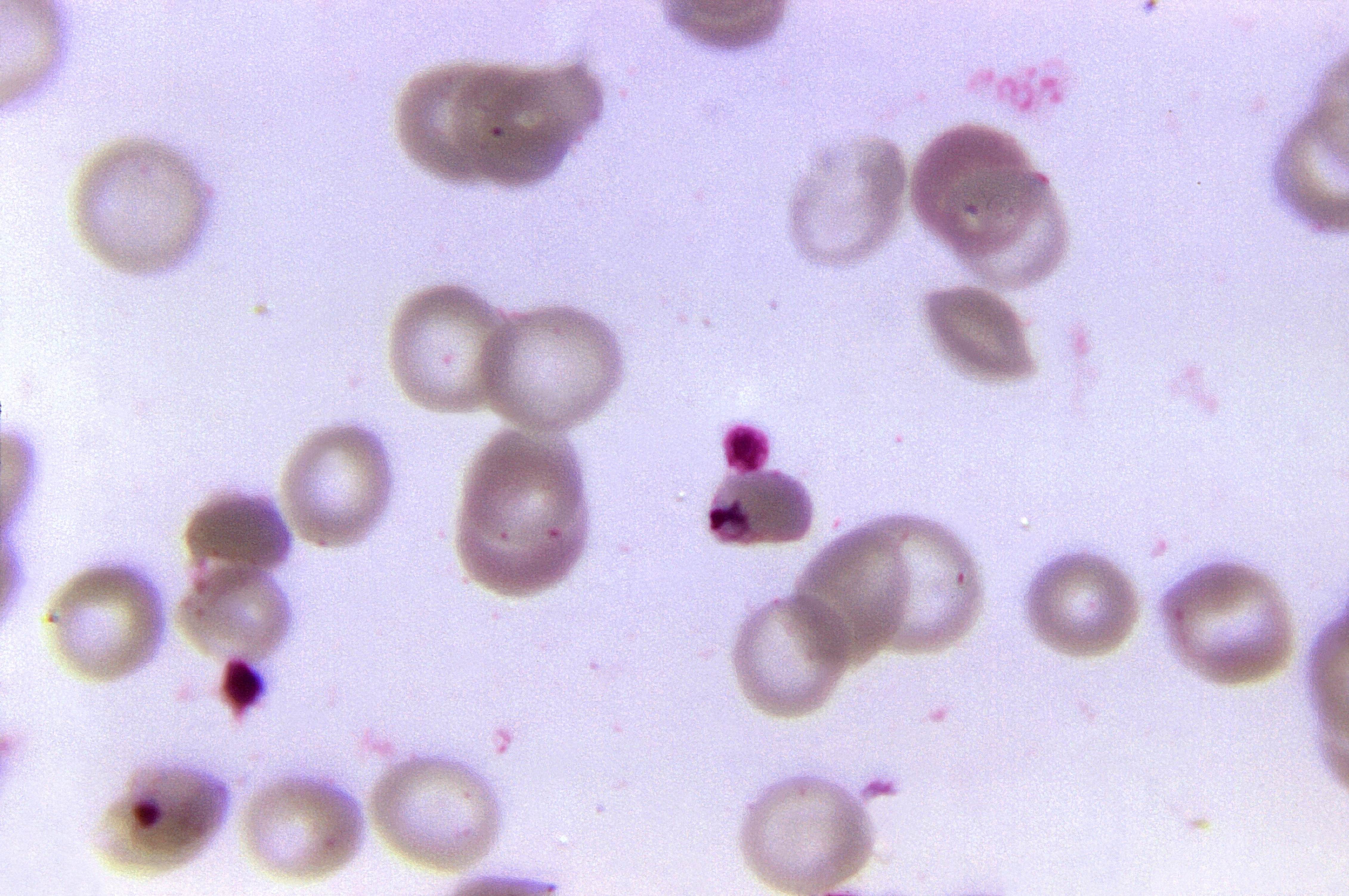 malaria Malaria