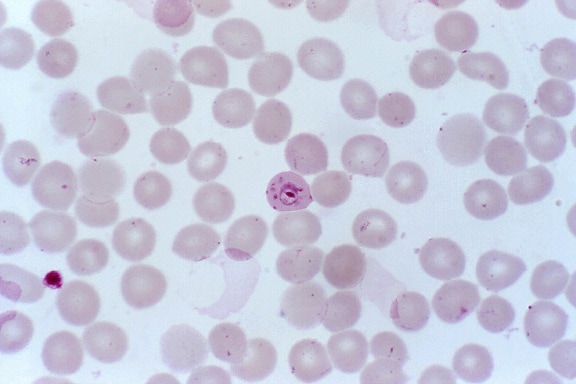 Plasmodiumfalciparum, ringar, delikat, cytoplasman, små, kromatin, prickar, infektion, röda blodkroppar, förstorad