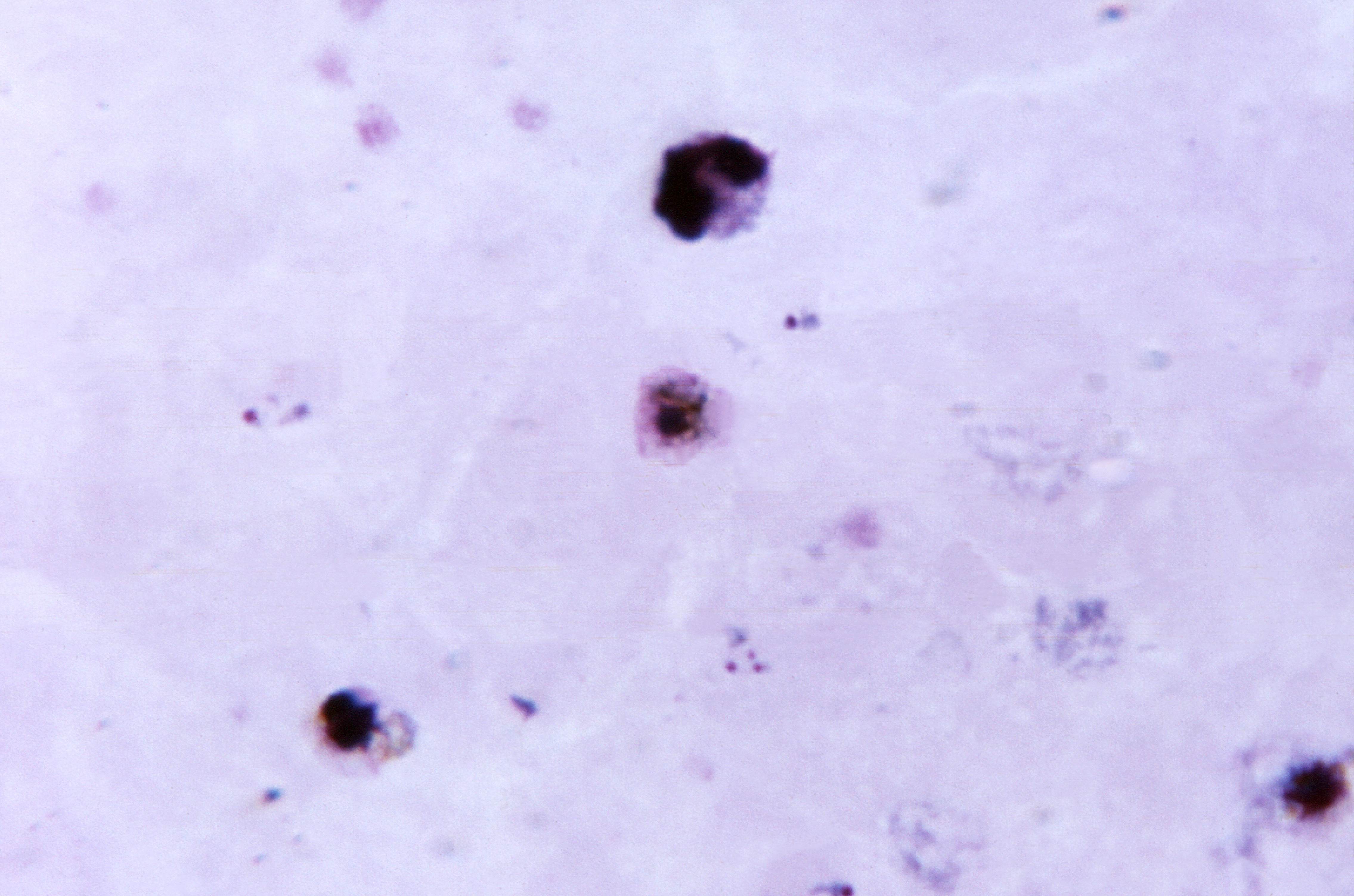 Цитоплазма Plasmodium. Plasmodium Vivax окраска. Малярийный плазмодий под микроскопом. Синцитий плазмодий. Многочисленные мелкие тельца