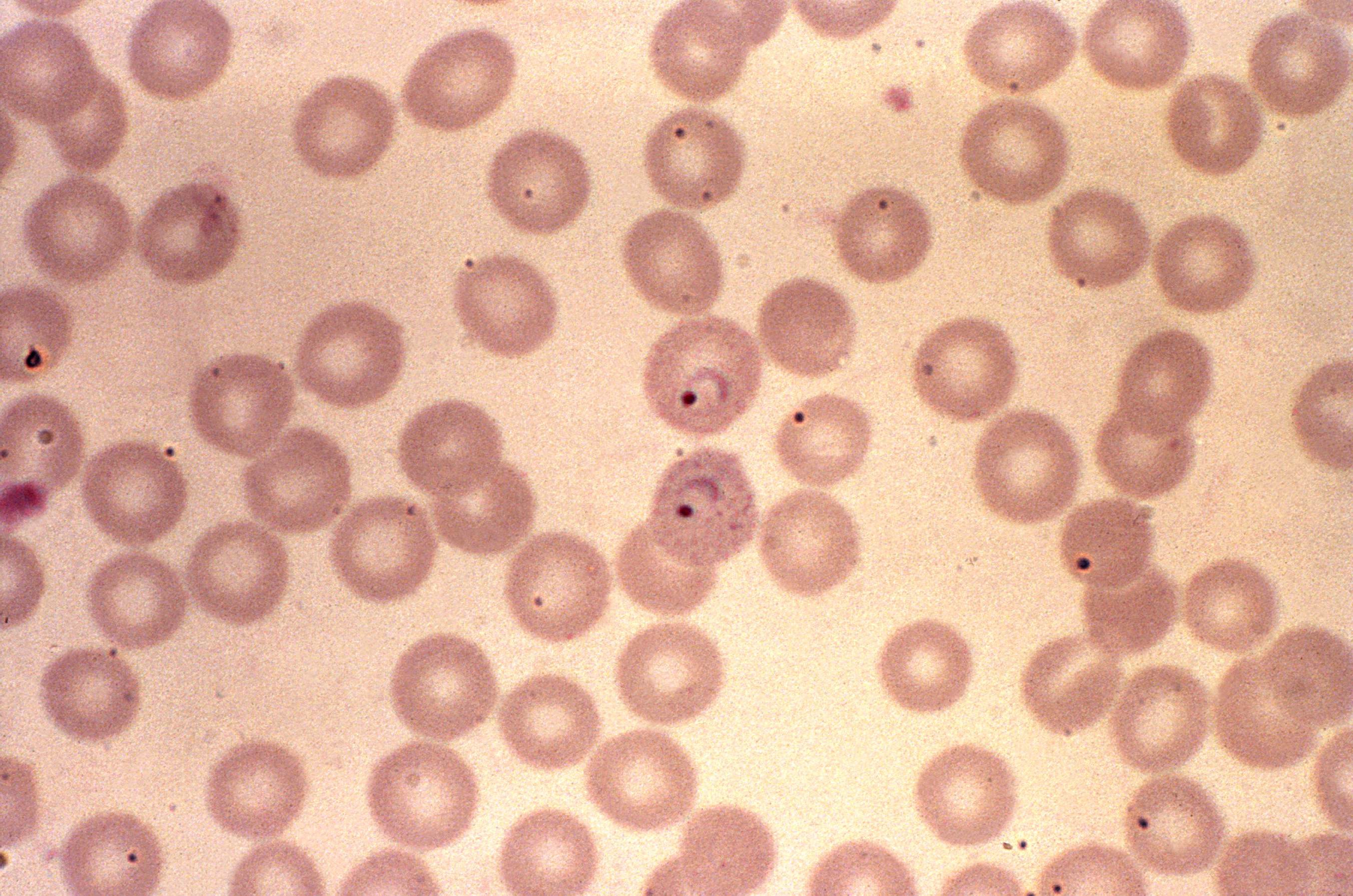 Малярийный плазмодий клетка. Малярийный плазмодий Вивакс. Плазмодий Вивакс у человека. Плазмодий Вивакс под микроскопом. Малярийный плазмодий под микроскопом.