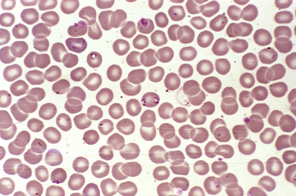 presence, determined, numbers, intraerythrocytic babesia, ring, form, parasites