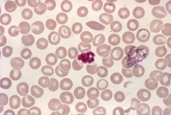 blood smear, micrograph, clump, platelets, resembled, malaria, schizont, stain, mag, 1000x