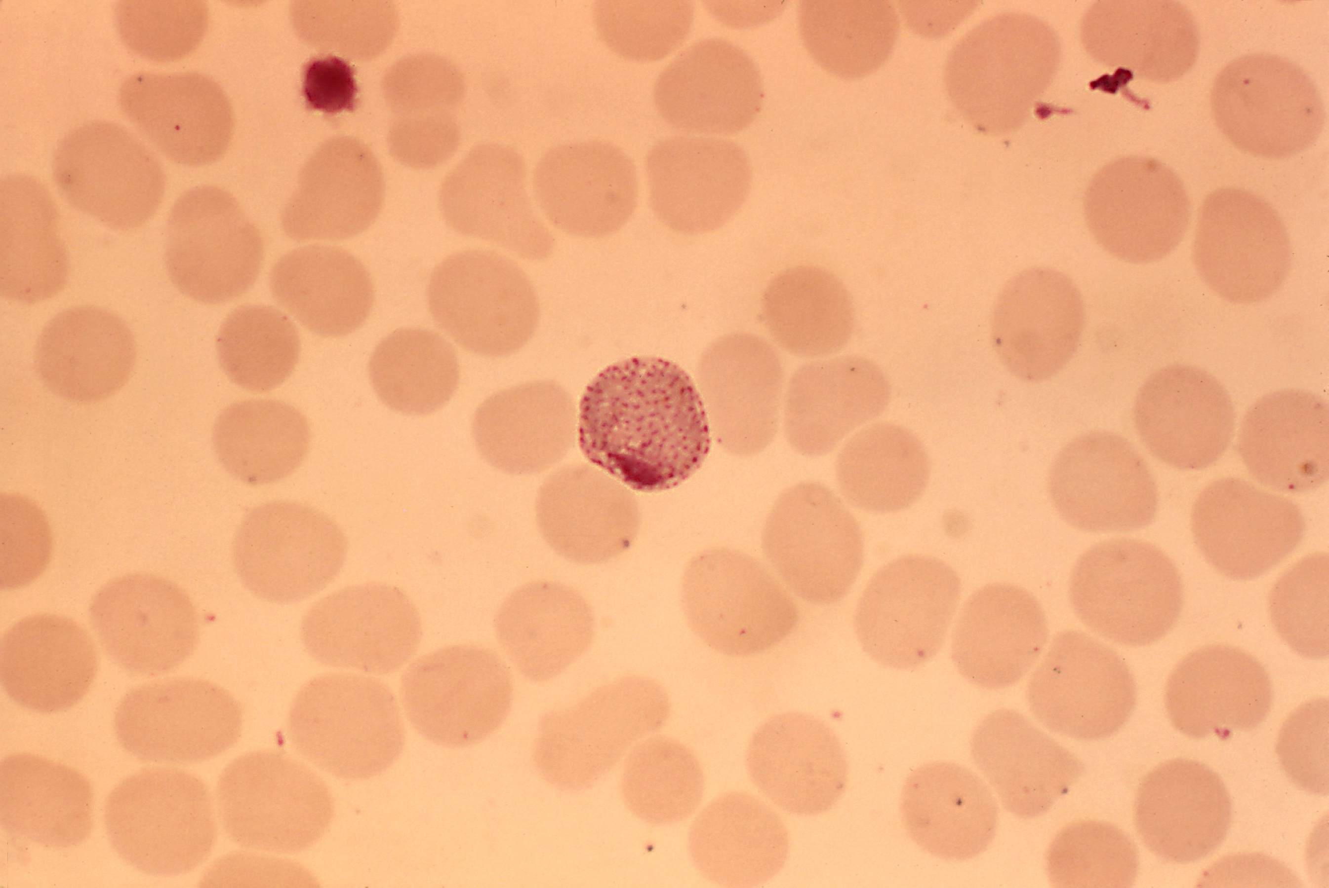 Малярия клетки. Плазмодий Vivax. Малярийный плазмодий микрофотография. Малярийный плазмодий мазок крови. Малярийный плазмодий Вивакс.