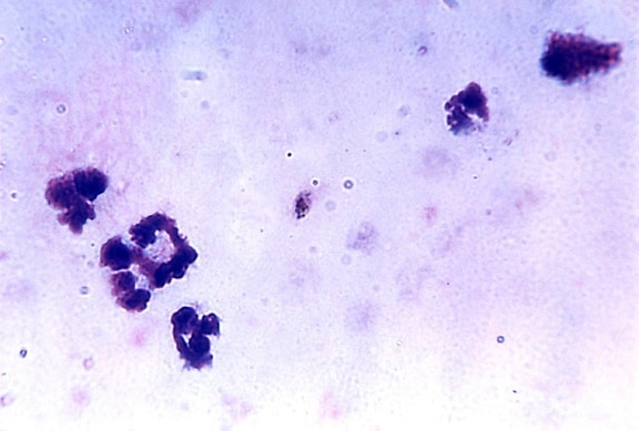 frotis de sangre, microfotografía, plasmodium falciparum, los gametocitos