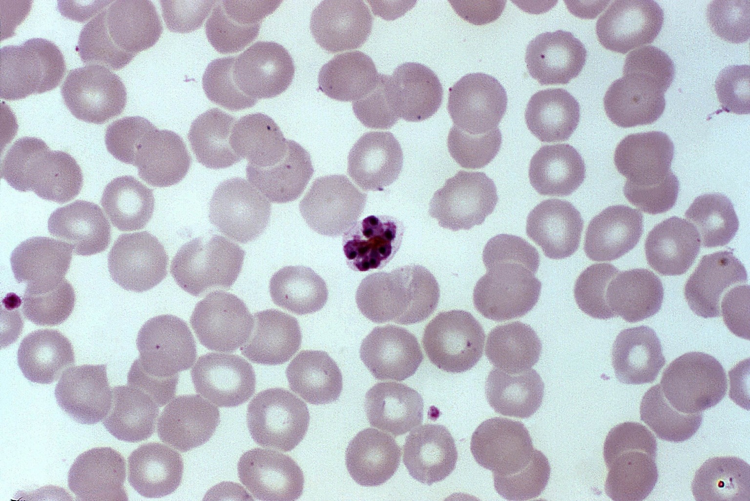 Плазмодий мазок. Plasmodium falciparum в мазке крови. Малярийный плазмодий под микроскопом. Малярийный плазмодий в мазке крови. Сетчатый плазмодий.