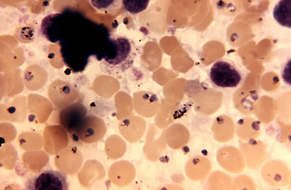 μικρογραφία, σπλήνα, ιστών, αυτοψία, malariae, λάδι, βύθιση, τεχνική, mag, 1125 x