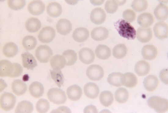 Free Picture Photomicrograph Shows Mature Plasmodium Malariae Trophozoite Infection