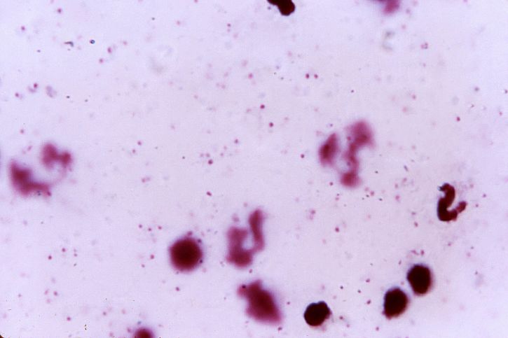 thick, film, blood smear, micrograph, numerous, ring, form, plasmodium falciparum, trophozoites