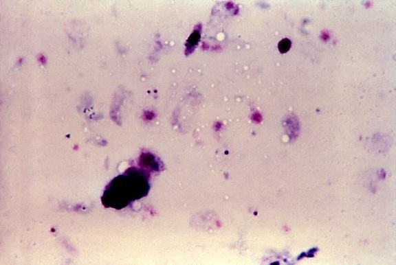 厚, 膜, 血涂片, 三, 恶性疟原虫, 环, 一, 染色质, 点, 拉长, gametocyte