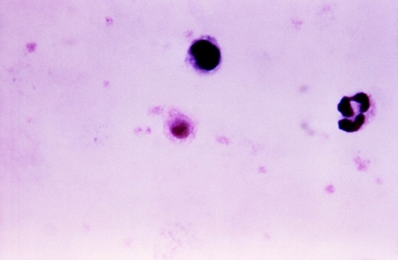 gruesa, película, micrografía, Plasmodium vivax, gametocitos
