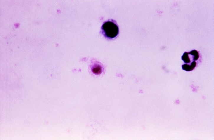 tjock, film, Mikrograf, plasmodium vivax, gametocyte