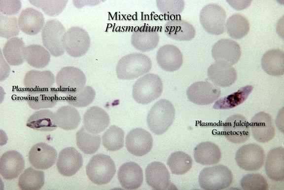 gruesa, película, micrografía, mezclado, Plasmodium falciparum, malariae, parasitaria, infección