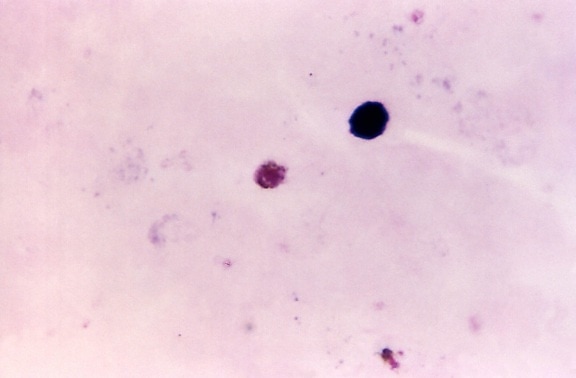thick, film, photomicrograph, plasmodium malariae, gametocyte, stain, technique