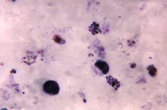 thick, film, photomicrograph, indicates, presence, mixed, plasmodium infection
