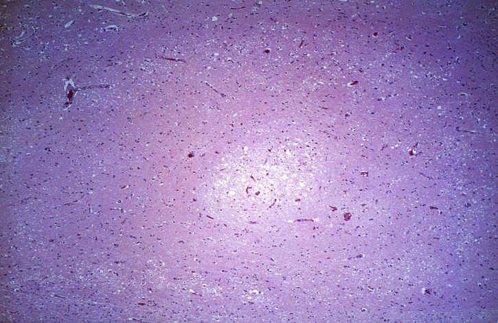Nipah-vírus vizsgálata, minták, kitörés, agyvelőgyulladás