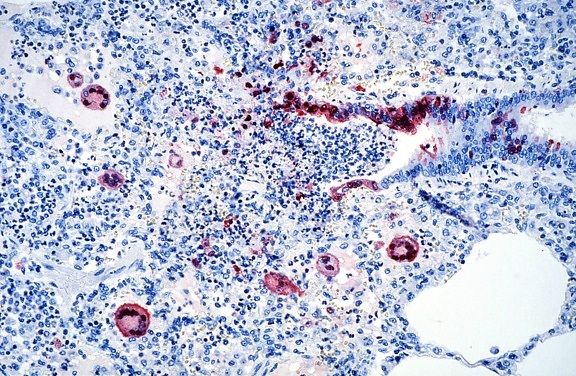 photomicrograph histopatologiset, toi, nipah-virus, infektio