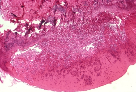 Микрография, показва, хистологични, човешкото, кожата, инфекция, вариола, петното
