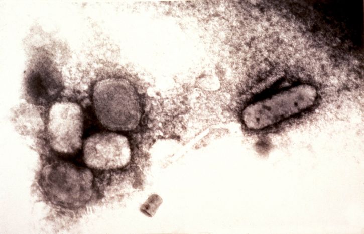 บอร์ด variola ฝีดาษ ไวรัส ลบ สี ย้อม เทคนิค ขยาย 65000 x
