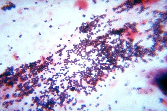 estafilococos, bacterias, gramo, mancha, la técnica, el paciente, estafilocócica, neumonía