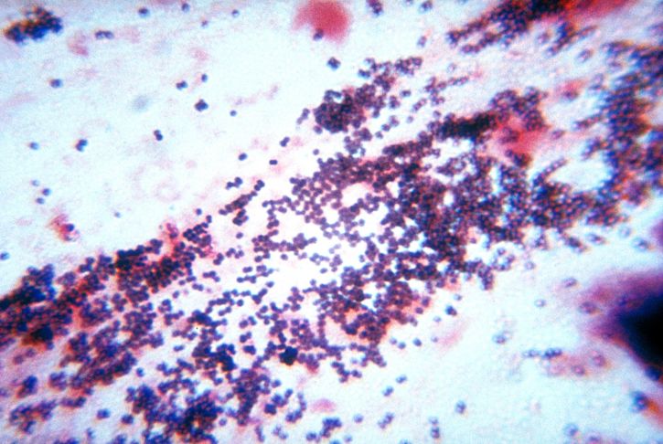 staphylococcus, bacteria, gram, stain, technique, patient, staphylococcal pneumonia