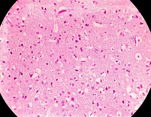 photomicrograph, venezuelansk, encephalitis, neurale, nekrose, ødem