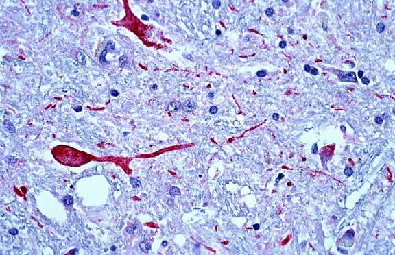 photomicrograph solut, aivot, kudos, west, Niilin enkefaliitti, potilaan veren
